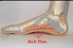 Plantar Fasciitis procedure and Effective Healing